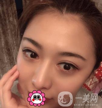延吉金光善整形美容醫(yī)院價格表收費明細_雙眼皮手術真人體驗分享