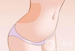 腰腹吸脂多久消腫?多久看到果?
