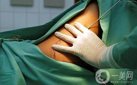 關(guān)于吸脂手術(shù)的流程與*性，你都知道嗎？