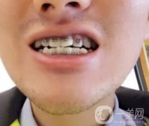濰坊市人民醫(yī)院整牙多少錢？牙齒矯正價(jià)格及果展示