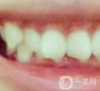 張家港澳洋醫(yī)院整牙怎么樣？牙齒矯正價(jià)格及經(jīng)歷分享