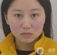 武漢市第一醫(yī)院*多少錢？美容科案例精選