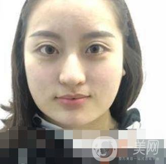 河北省人民醫(yī)院整形外科價(jià)格表新版來(lái)襲，附去下頜骨案例