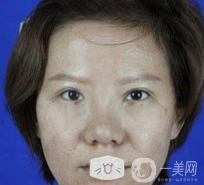 綿陽中心醫(yī)院整形美容科價格表2020發(fā)布，附祛眼袋案例