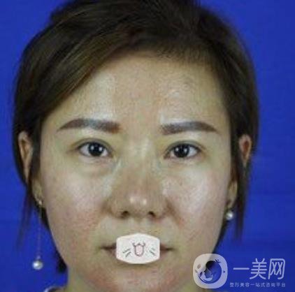 綿陽中心醫(yī)院整形美容科價格表2020發(fā)布，附祛眼袋案例