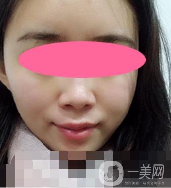 寧波第一醫(yī)院整形科價格表收費明細上線，看打玻尿酸真人案例