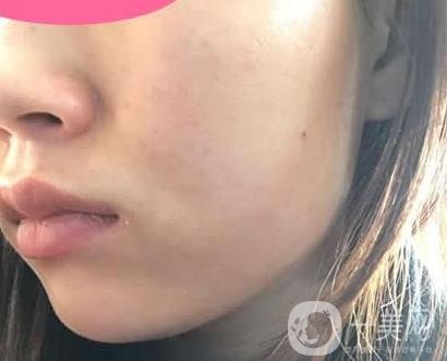 寧波第一醫(yī)院整形科價格表收費明細上線，看打玻尿酸真人案例