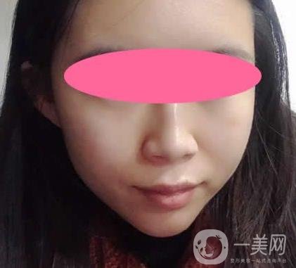 寧波第一醫(yī)院整形科價格表收費明細上線，看打玻尿酸真人案例