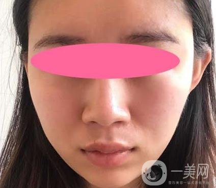 寧波第一醫(yī)院整形科價格表收費明細上線，看打玻尿酸真人案例