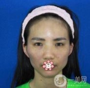 上海第九人民醫(yī)院整形外科價(jià)格表，附面部脂肪填充案例