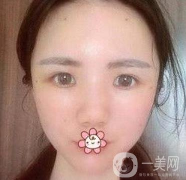 上海第九人民醫(yī)院整形外科價(jià)格表，附面部脂肪填充案例