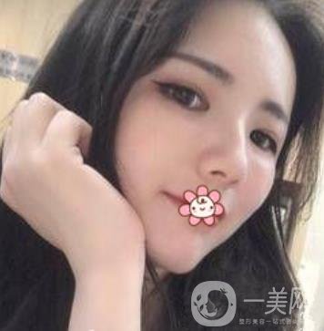 上海第九人民醫(yī)院整形外科價(jià)格表，附面部脂肪填充案例