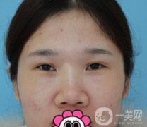 2020北京大學(xué)深圳醫(yī)院整形科價(jià)格表，附雙眼皮案例