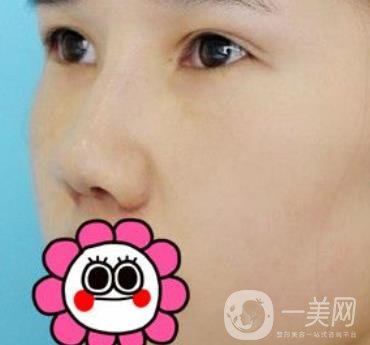 2020北京大學(xué)深圳醫(yī)院整形科價(jià)格表，附雙眼皮案例