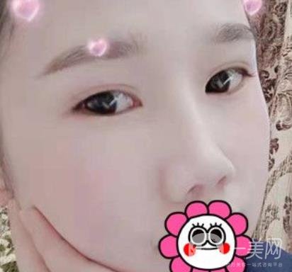 2020北京大學(xué)深圳醫(yī)院整形科價(jià)格表，附雙眼皮案例
