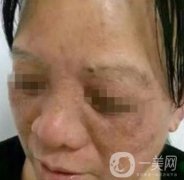 廣東省人民醫(yī)院整形科價(jià)格表，附祛斑整形日記