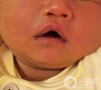 昆明醫(yī)科大學(xué)第一附屬醫(yī)院整形科價格表，內(nèi)附兔唇矯正案例