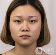 西安市中心醫(yī)院整形科價格表，內(nèi)附韓悅雙眼皮真人案例