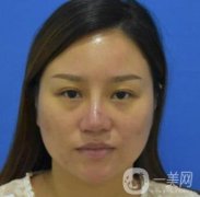 張掖市人民醫(yī)院美容整形科價格表，附眼袋切除果圖