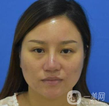 張掖市人民醫(yī)院美容整形科價格表，附眼袋切除*果圖