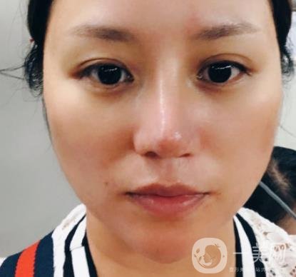 張掖市人民醫(yī)院美容整形科價格表，附眼袋切除*果圖