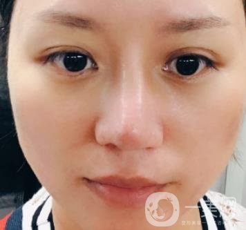 張掖市人民醫(yī)院美容整形科價格表，附眼袋切除*果圖