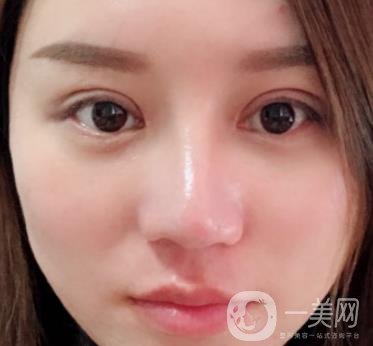 張掖市人民醫(yī)院美容整形科價格表，附眼袋切除*果圖