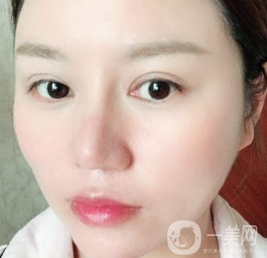 張掖市人民醫(yī)院美容整形科價格表，附眼袋切除*果圖