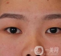 北京醫(yī)院整形項目2020年價格表一覽，內(nèi)附錢文江開眼角案例