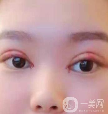 北京醫(yī)院整形項目2020年價格表一覽，內附錢文江開眼角案例