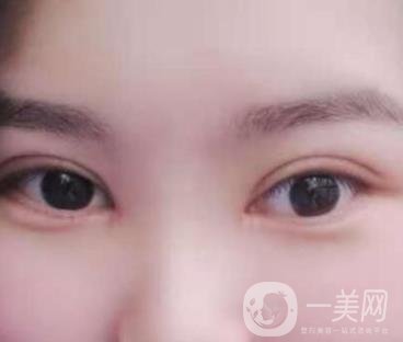 北京醫(yī)院整形項目2020年價格表一覽，內附錢文江開眼角案例
