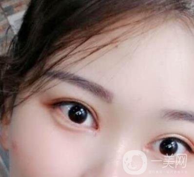 北京醫(yī)院整形項目2020年價格表一覽，內附錢文江開眼角案例