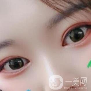 北京醫(yī)院整形項目2020年價格表一覽，內附錢文江開眼角案例