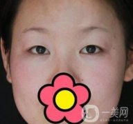 甘肅省人民醫(yī)院割雙眼皮怎么樣？附整形價(jià)格表及真人案例