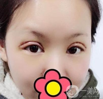 甘肅省人民醫(yī)院割雙眼皮怎么樣？附整形價(jià)格表及真人案例