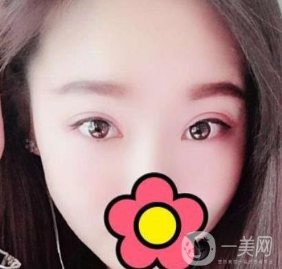 甘肅省人民醫(yī)院割雙眼皮怎么樣？附整形價(jià)格表及真人案例