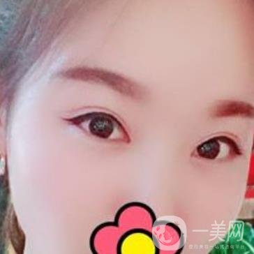甘肅省人民醫(yī)院割雙眼皮怎么樣？附整形價(jià)格表及真人案例