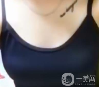 廣東省第二人民醫(yī)院隆胸手術(shù)多少錢？羅盛康案例？附整形價(jià)格表
