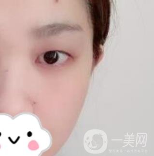 湖南省人民醫(yī)院割雙眼皮要多少錢(qián)？整形價(jià)格表一覽