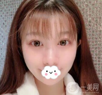 湖南省人民醫(yī)院割雙眼皮要多少錢(qián)？整形價(jià)格表一覽