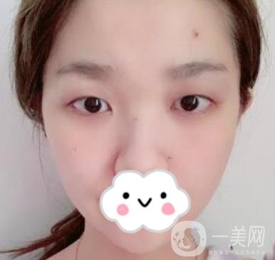 湖南省人民醫(yī)院割雙眼皮要多少錢(qián)？整形價(jià)格表一覽