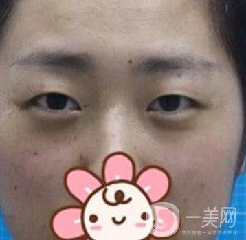 秦皇島人民醫(yī)院雙眼皮怎么樣？附整形價(jià)格表及案例圖