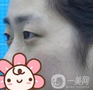 秦皇島人民醫(yī)院雙眼皮怎么樣？附整形價(jià)格表及案例圖