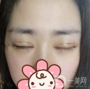 秦皇島人民醫(yī)院雙眼皮怎么樣？附整形價(jià)格表及案例圖