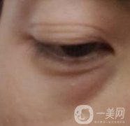 寶雞市人民醫(yī)院美容科價(jià)格表，去眼袋手術(shù)案例展示