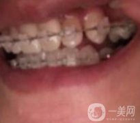 蘭山區(qū)人民醫(yī)院整牙多少錢？牙齒矯正案例分享