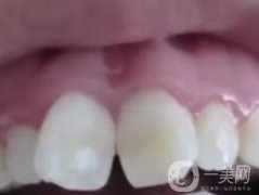 泉州人民醫(yī)院整牙多少錢？牙齒矯正恢復(fù)情況介紹