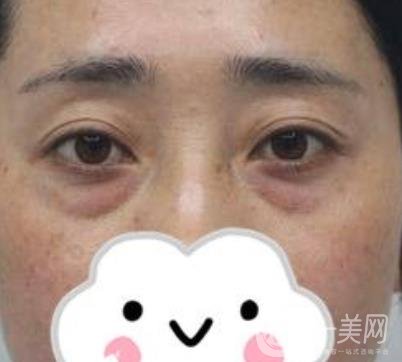 第九人民醫(yī)院去眼袋