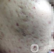 綿陽中心醫(yī)院整形美容科祛痘坑怎么樣？價(jià)格表及術(shù)后果分享