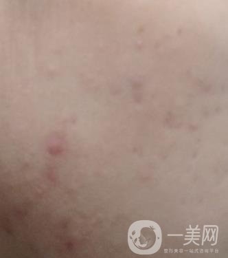 綿陽(yáng)中心醫(yī)院整形美容科祛痘坑怎么樣？?jī)r(jià)格表及術(shù)后*果分享
